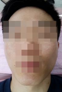 치료 후