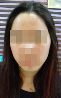 치료 전