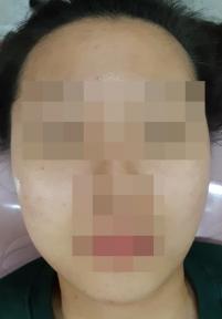 치료 후