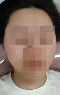 치료 후
