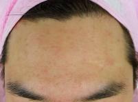 치료 후