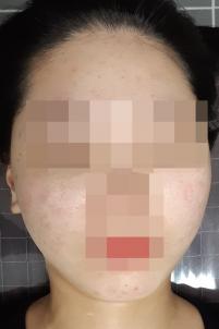 치료 후