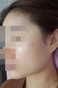 치료 후