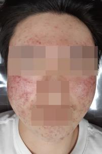 치료 전