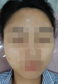 치료 후