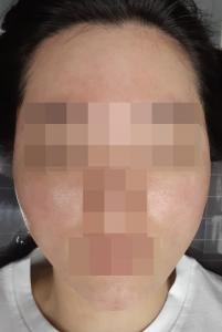 치료 후