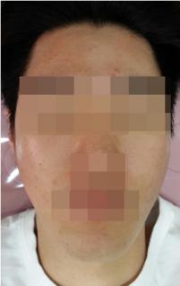 치료 후