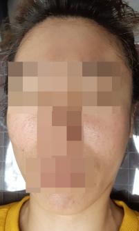 치료 후