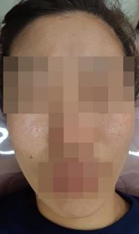 치료 전