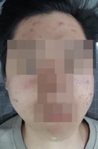 치료 전