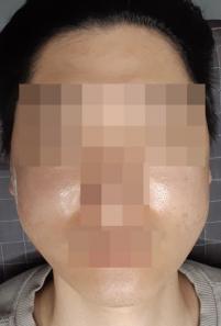치료 후