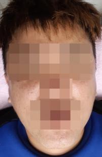 치료 후