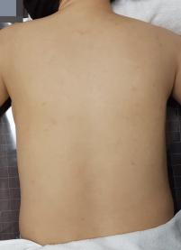 치료 후