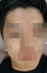 치료 전
