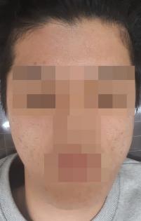 치료 후