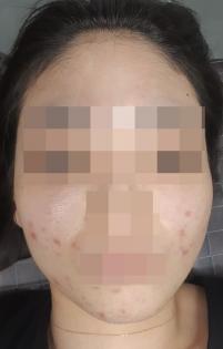 치료 전