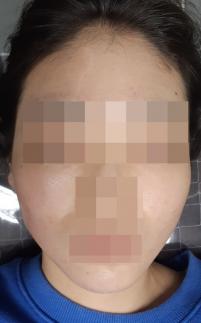 치료 후