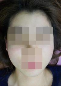 치료 후