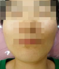 치료 후