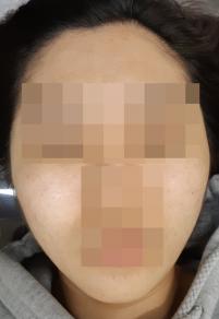 치료 후