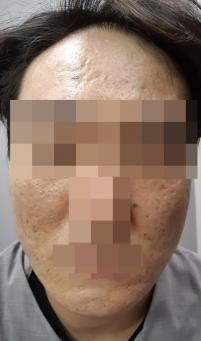 치료 후