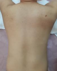 치료 후