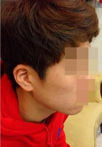치료 전