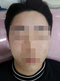 치료 후