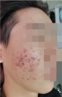 치료 전