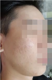 치료 후