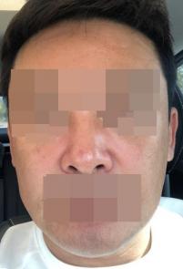 치료 후
