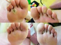 치료 후
