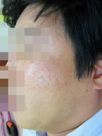 치료 후