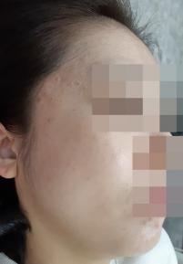치료 전