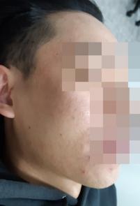치료 후