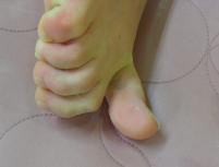 치료 후