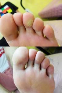 치료 전