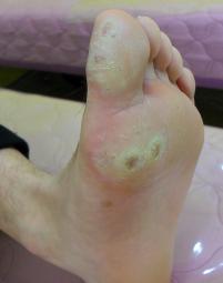 치료 전