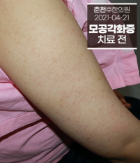치료 전