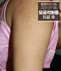 치료 후