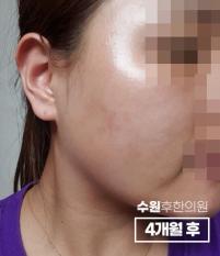 치료 후