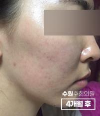 치료 후