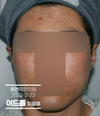 치료 후