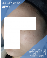치료 후