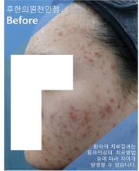 치료 전