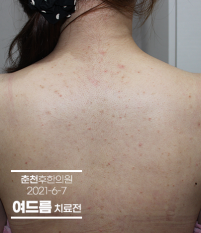 치료 전