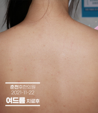치료 후