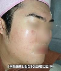 치료 후