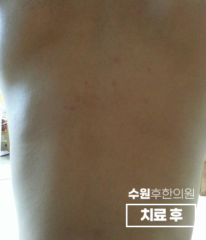 치료 후