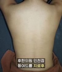 치료 후